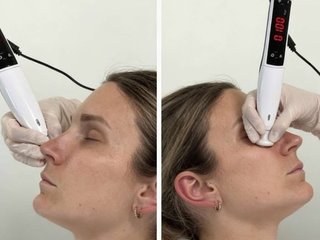 SOIN VISAGE PEAU ÉCLATANTE – PLASMA FROID